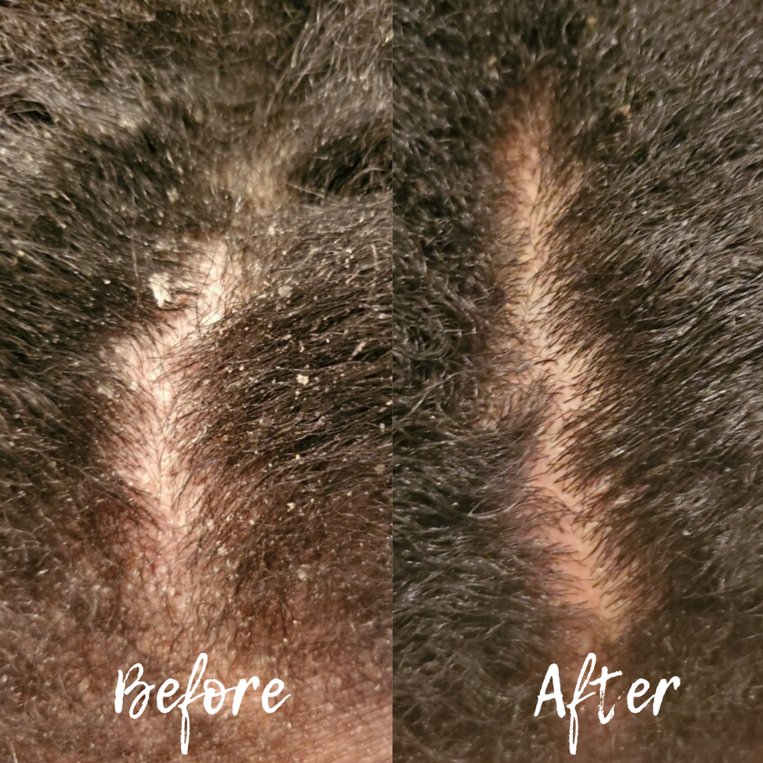 How to Heal Scalp Eczema Opulent Hair Essentials